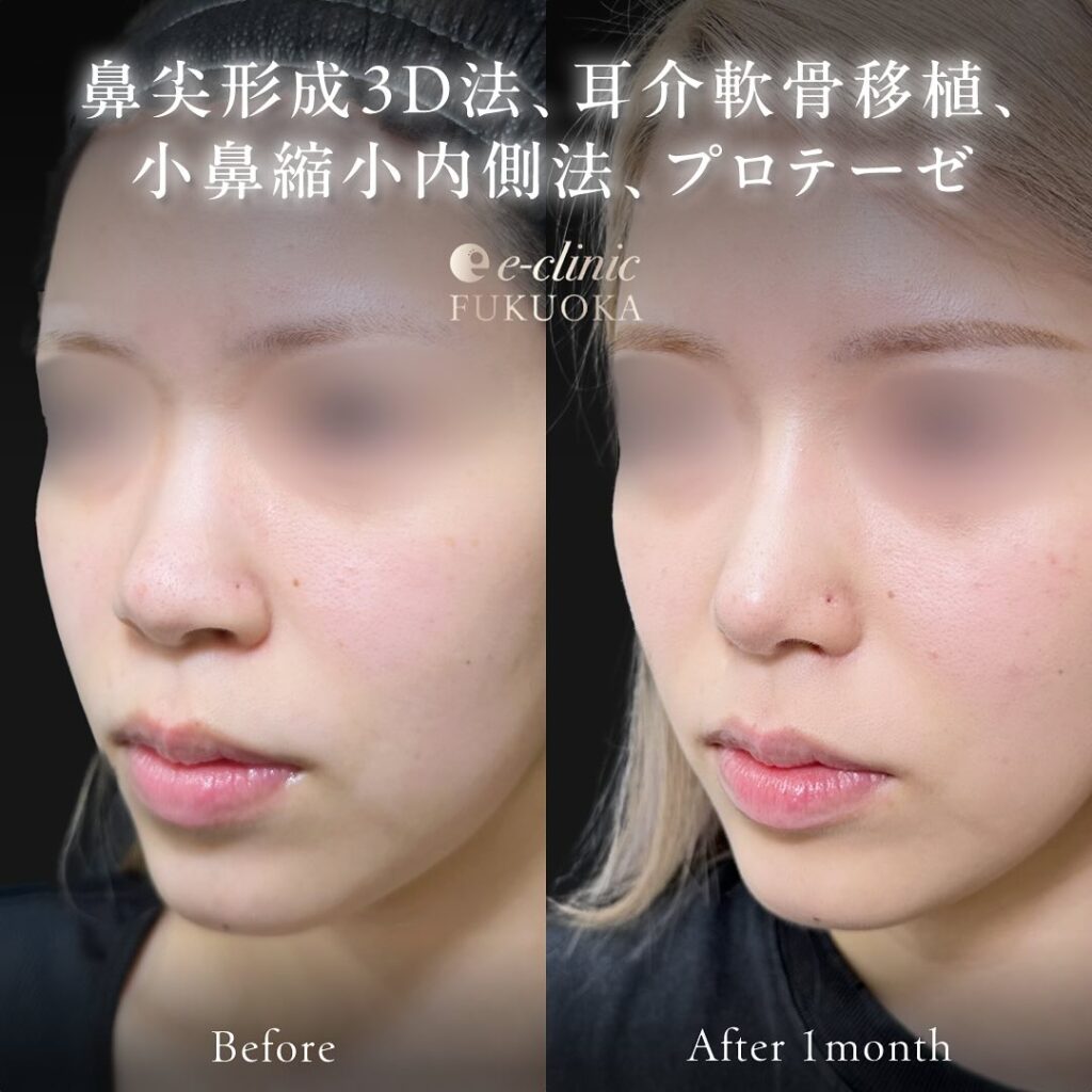 鼻尖形成と軟骨移植とプロテーゼと小鼻縮小の症例写真 (6)