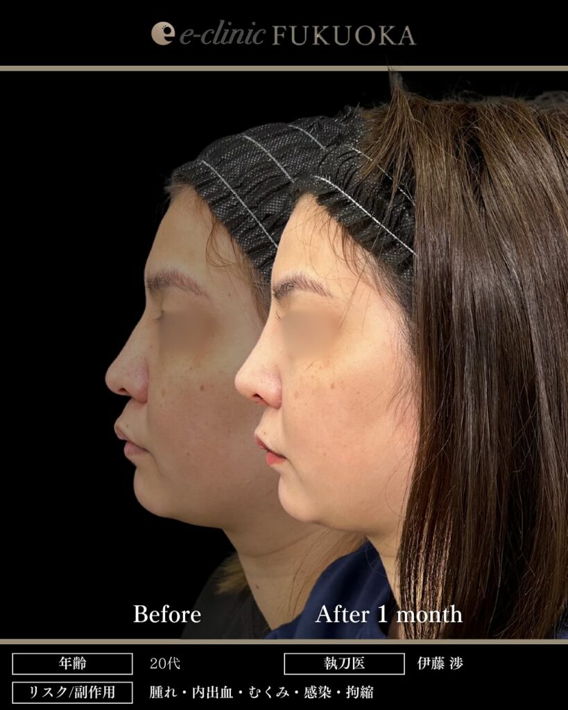 鼻尖形成と耳介軟骨移植と鼻柱下降とプロテーゼと小鼻縮小の症例写真 (3)