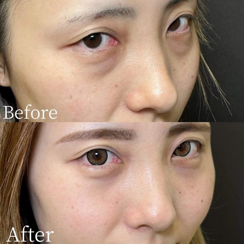 裏ハムラ法の症例写真 (26)