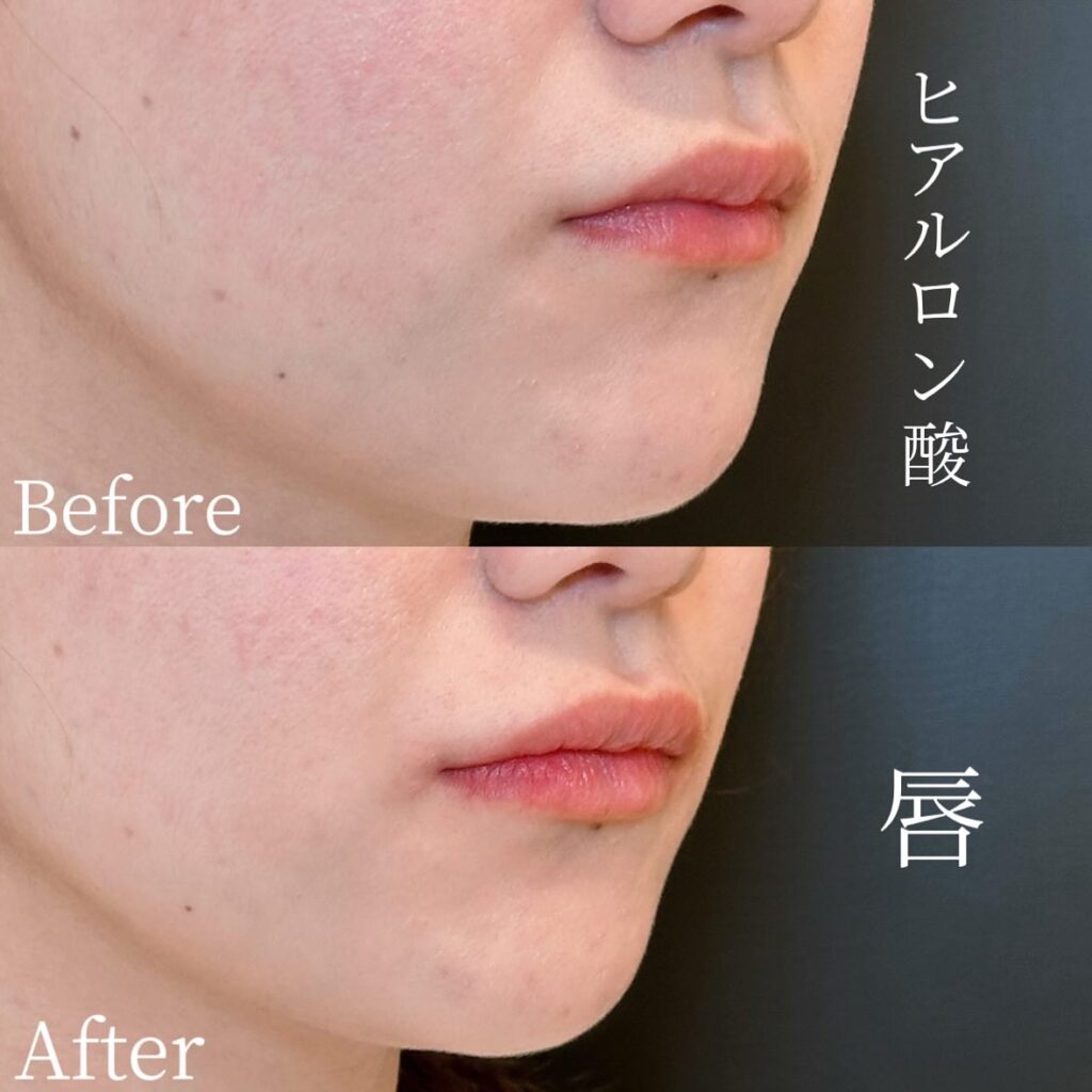 唇のヒアルロン酸の症例写真 (30)