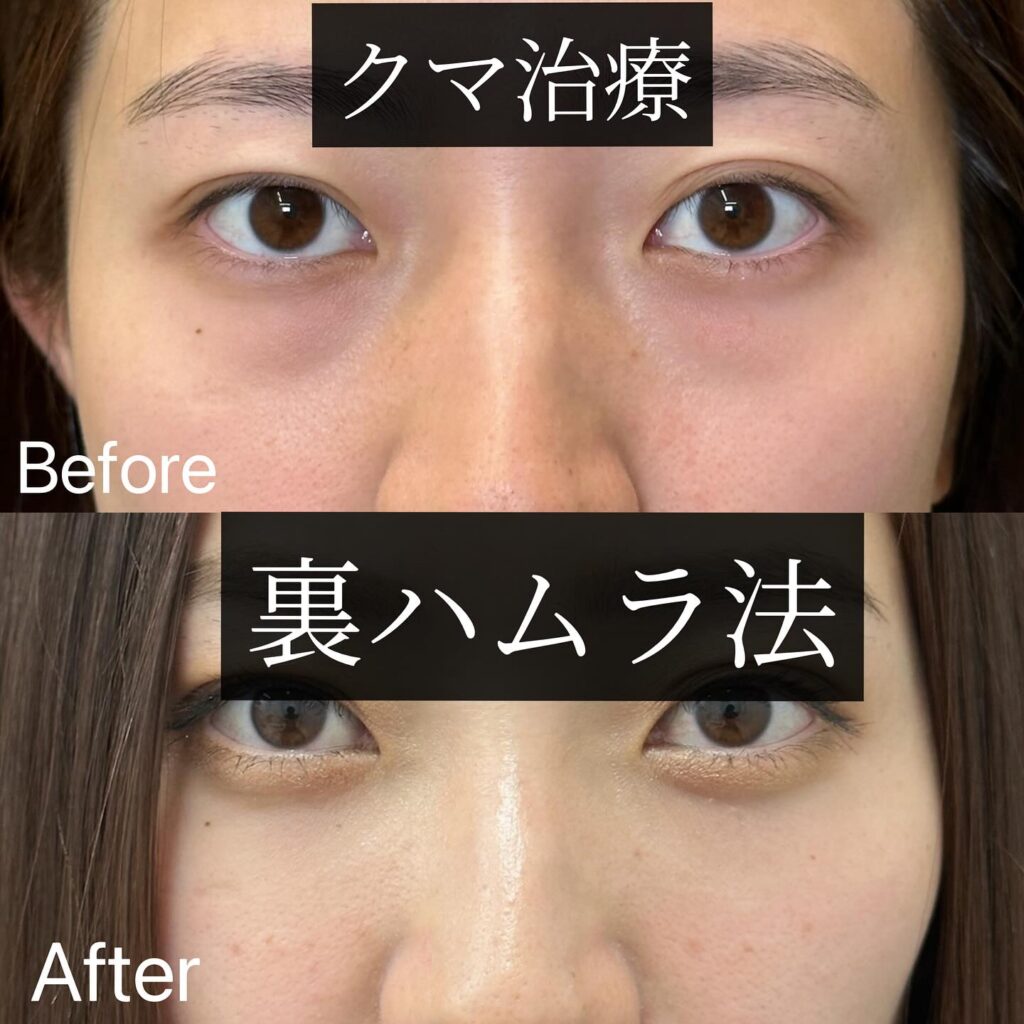 裏ハムラ法の症例写真 (23)