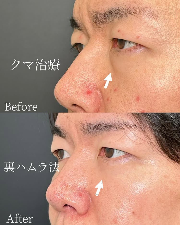 裏ハムラ法の症例写真 (50)