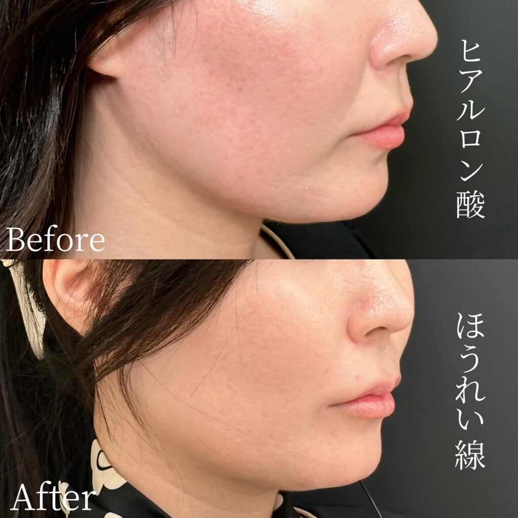 法令線のヒアルロン酸の症例写真 (19)