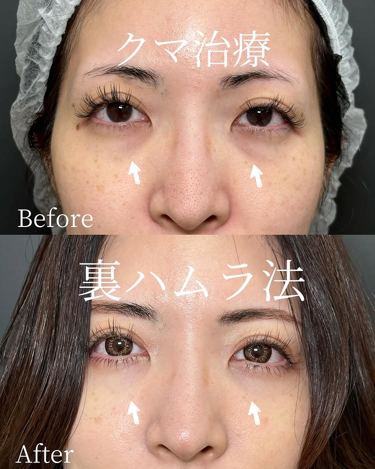 裏ハムラ法の症例写真 (85)