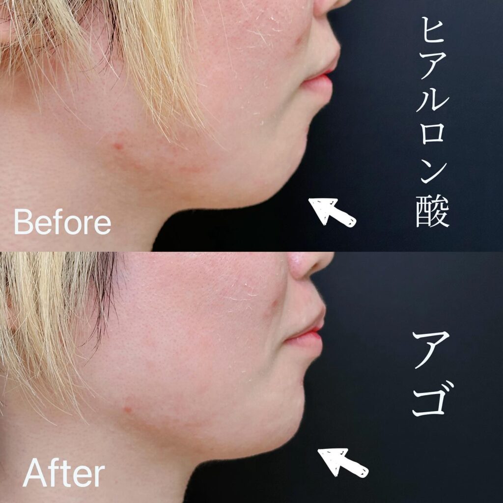 顎のヒアルロン酸の症例写真 (12)