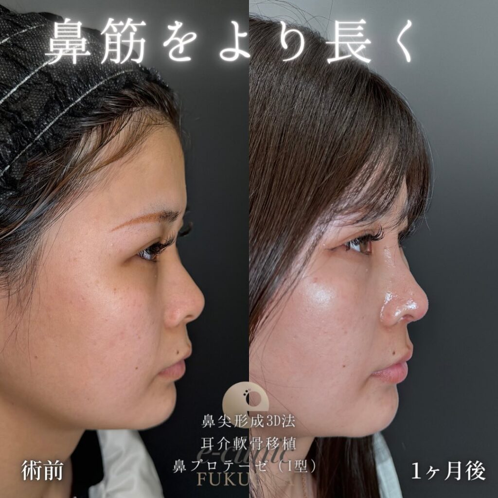 鼻尖形成と軟骨移植とプロテーゼの症例写真 (6)