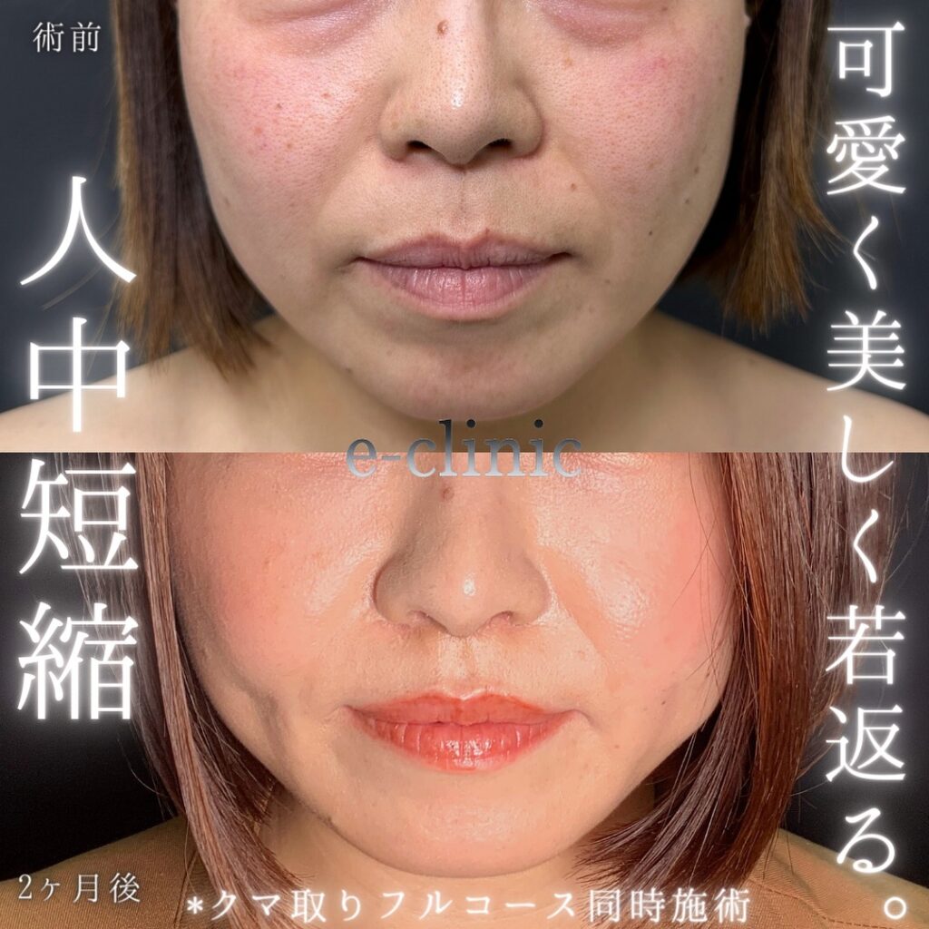 人中短縮の症例写真 (4)