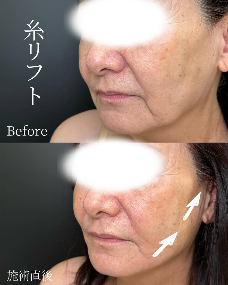 糸リフトの症例写真 (50)