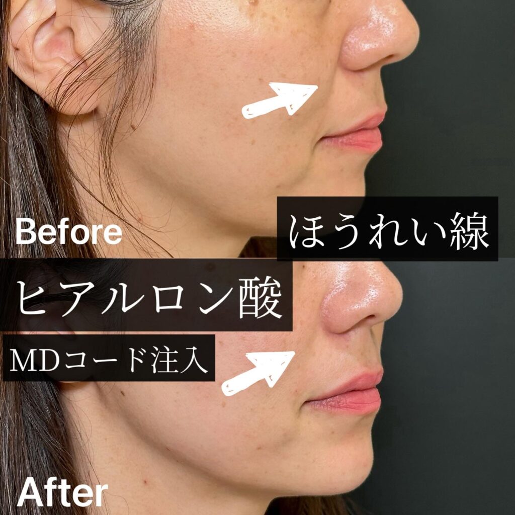 法令線のヒアルロン酸の症例 (1)