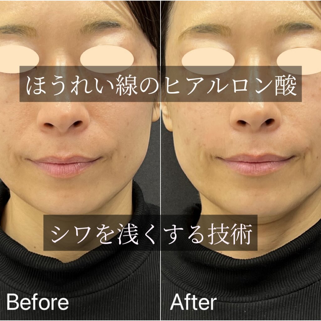 法令線のヒアルロン酸の症例写真 (3)
