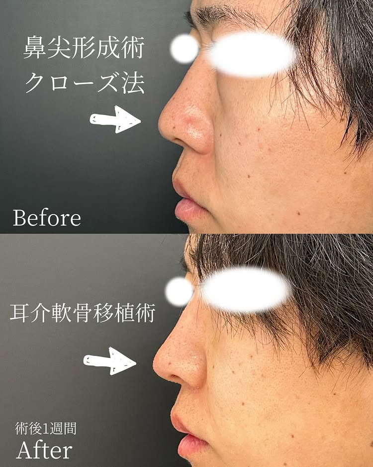 鼻尖形成と軟骨移植の症例写真 (17)