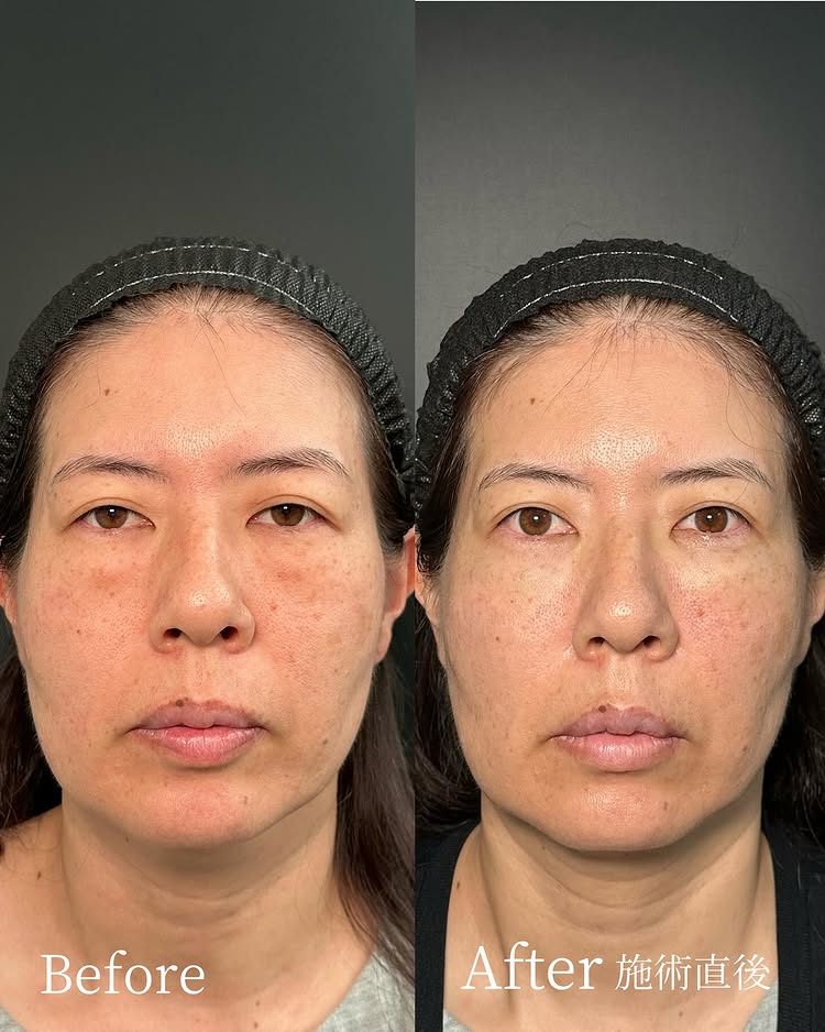 裏ハムラ法の症例写真 (76)