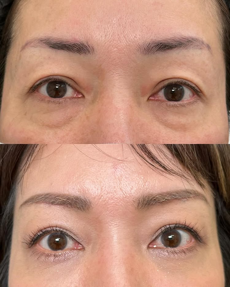 眉下切開の症例写真 (2)