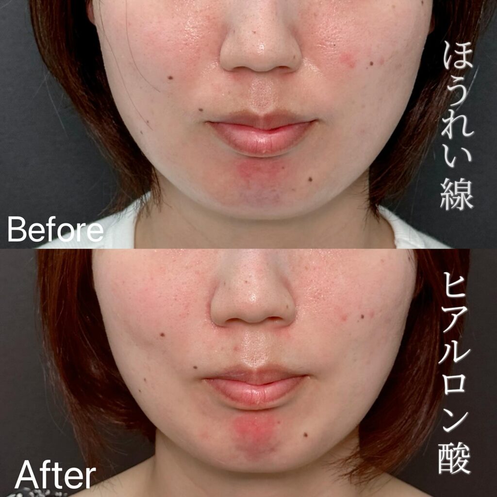 法令線のヒアルロン酸の症例写真 (17)
