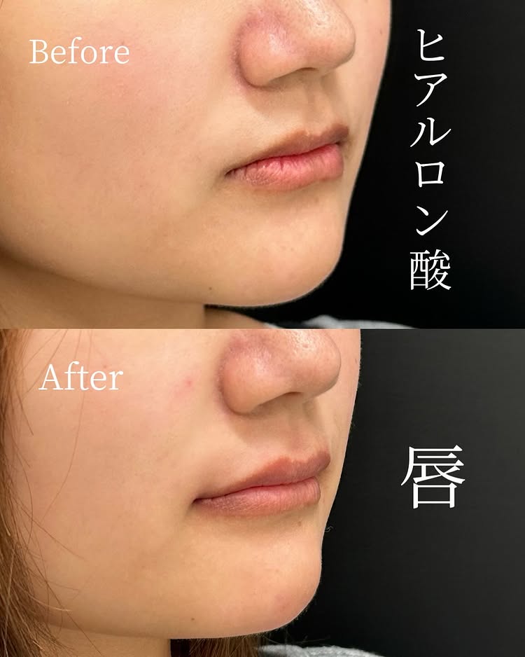 唇のヒアルロン酸の症例写真 (46)