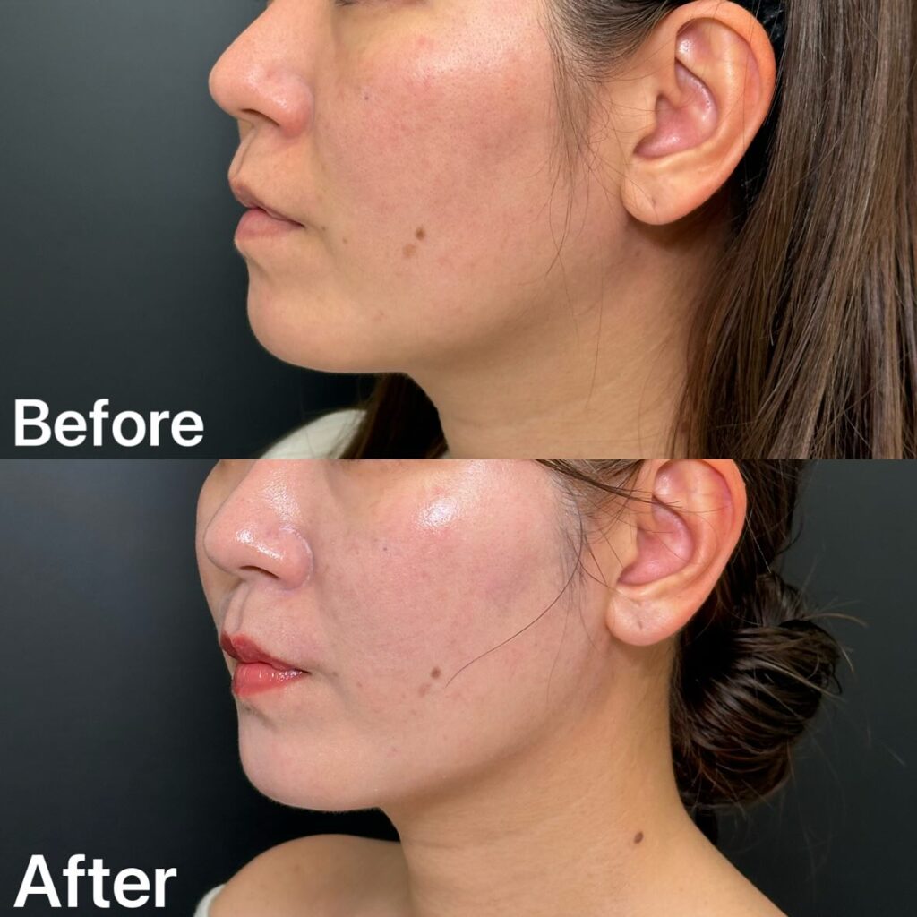 糸リフトの症例写真 (15)