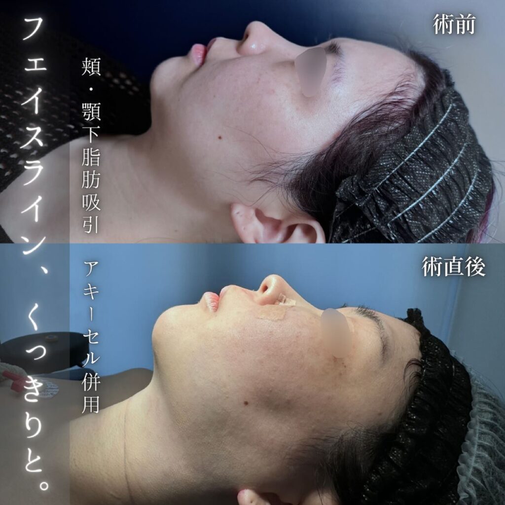 頬と顎下の脂肪吸引