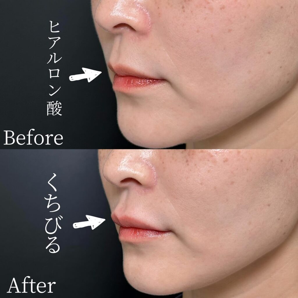 唇のヒアルロン酸の症例写真 (37)