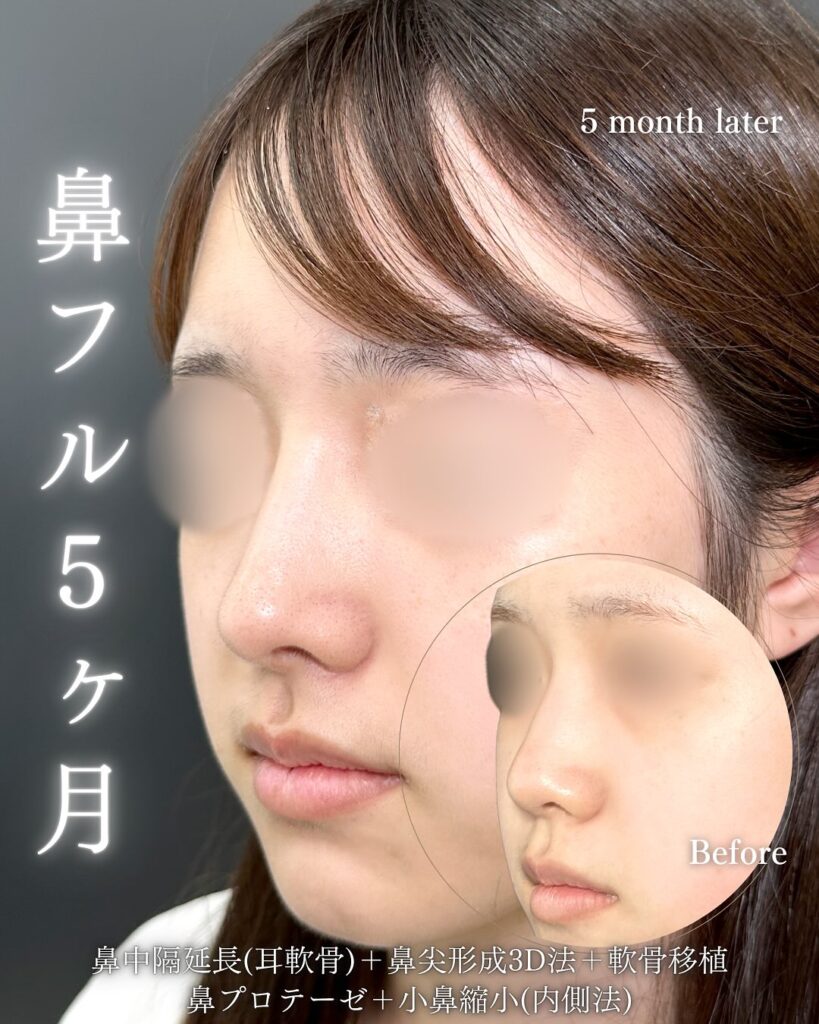 鼻中隔延長と鼻尖形成と耳介軟骨とプロテーゼと小鼻縮小と小鼻ボトックスの症例写真 (1)