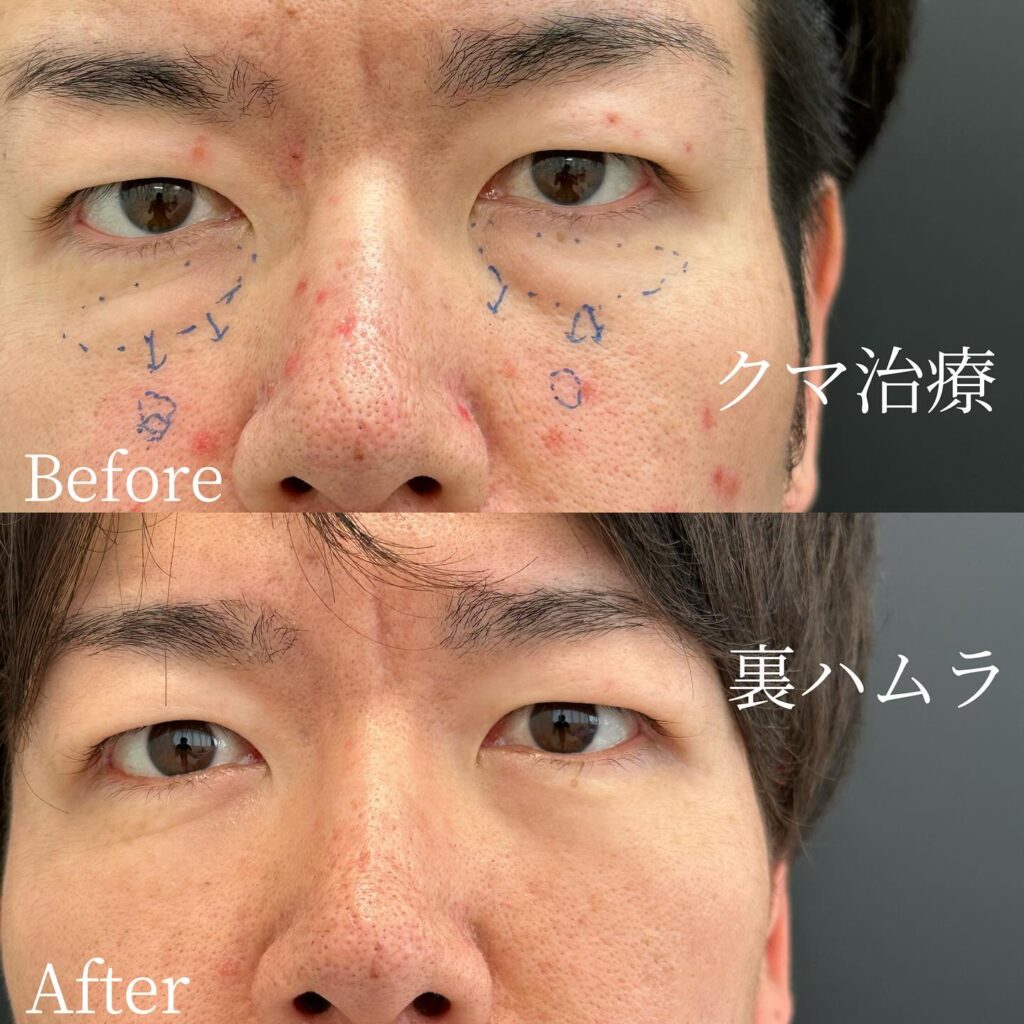 裏ハムラ法の症例写真 (43)