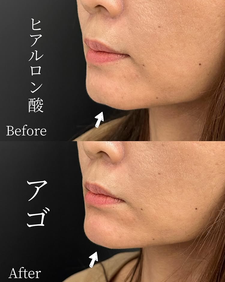 顎のヒアルロン酸の症例写真 (25)
