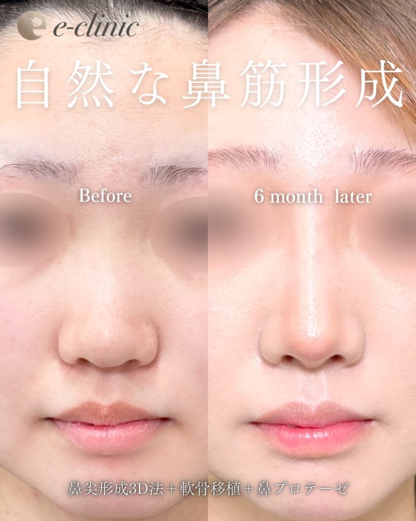 鼻尖形成と耳介軟骨移植とプロテーゼの症例写真 (5)