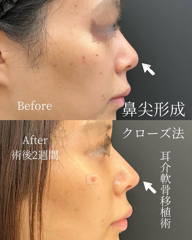 鼻尖形成と軟骨移植の症例写真 (9)