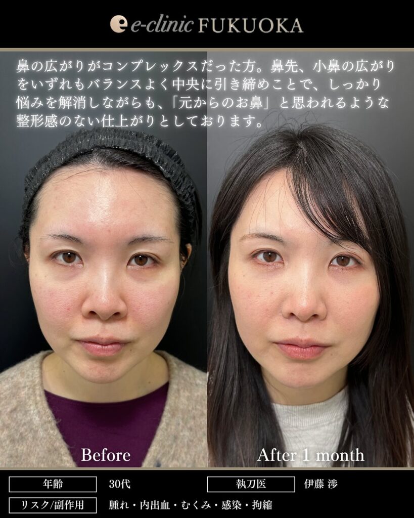 鼻尖形成と軟骨移植と小鼻縮小と裏ハムラ法と脂肪注入の症例写真 (3)