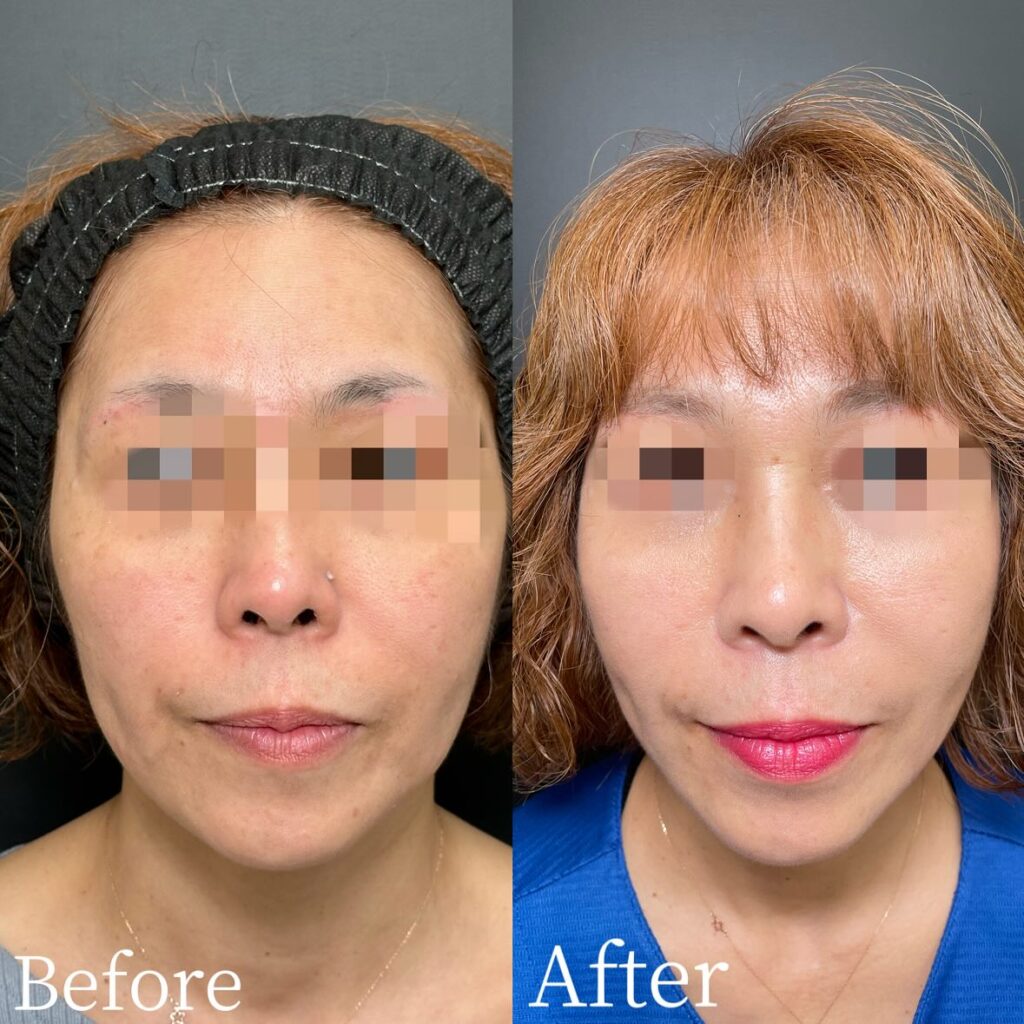 糸リフトの症例写真 (23)