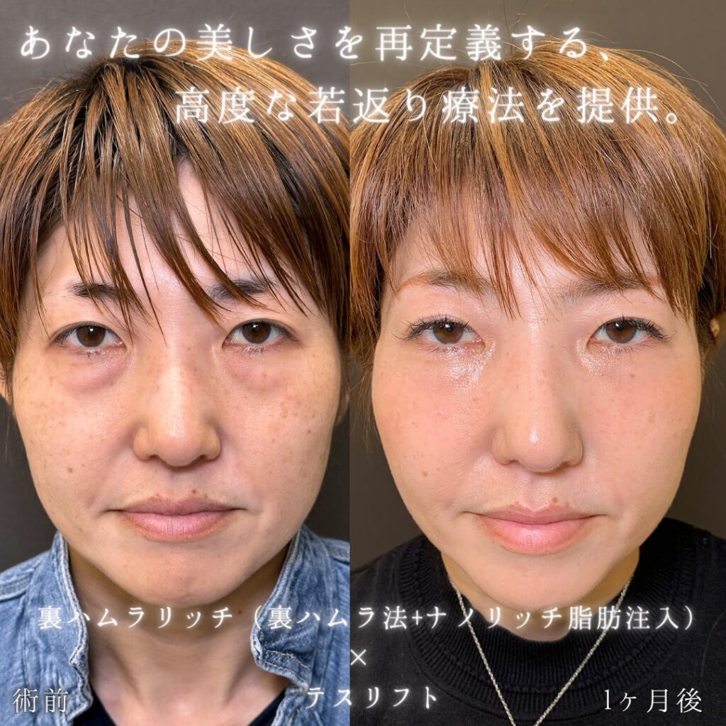 裏ハムラ法と脂肪注入の症例写真 (1)