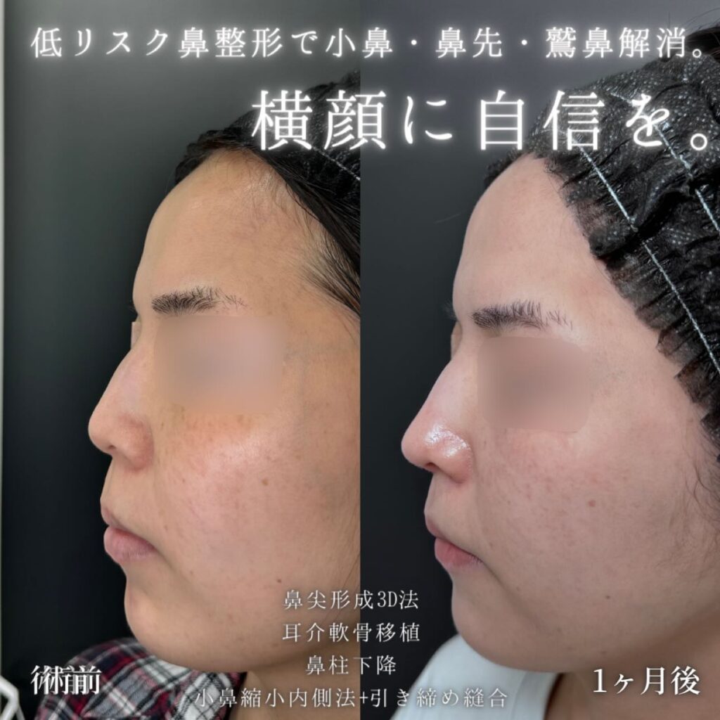 鼻尖形成と軟骨移植と鼻柱下降と小鼻縮小の症例写真 (3)