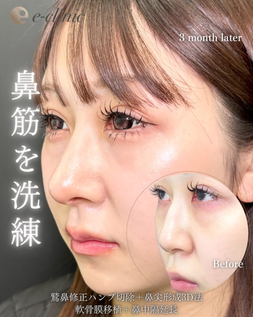 鼻中隔延長と鼻尖形成と軟骨移植と鷲鼻修正の症例写真 (12)