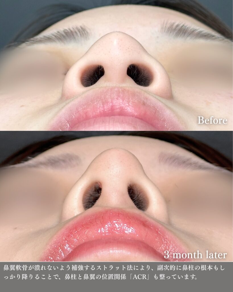 鼻尖形成と軟骨移植とプロテーゼと小鼻縮小の症例写真 (25)