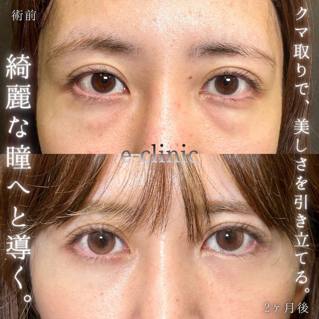 裏ハムラ法の症例写真 (27)