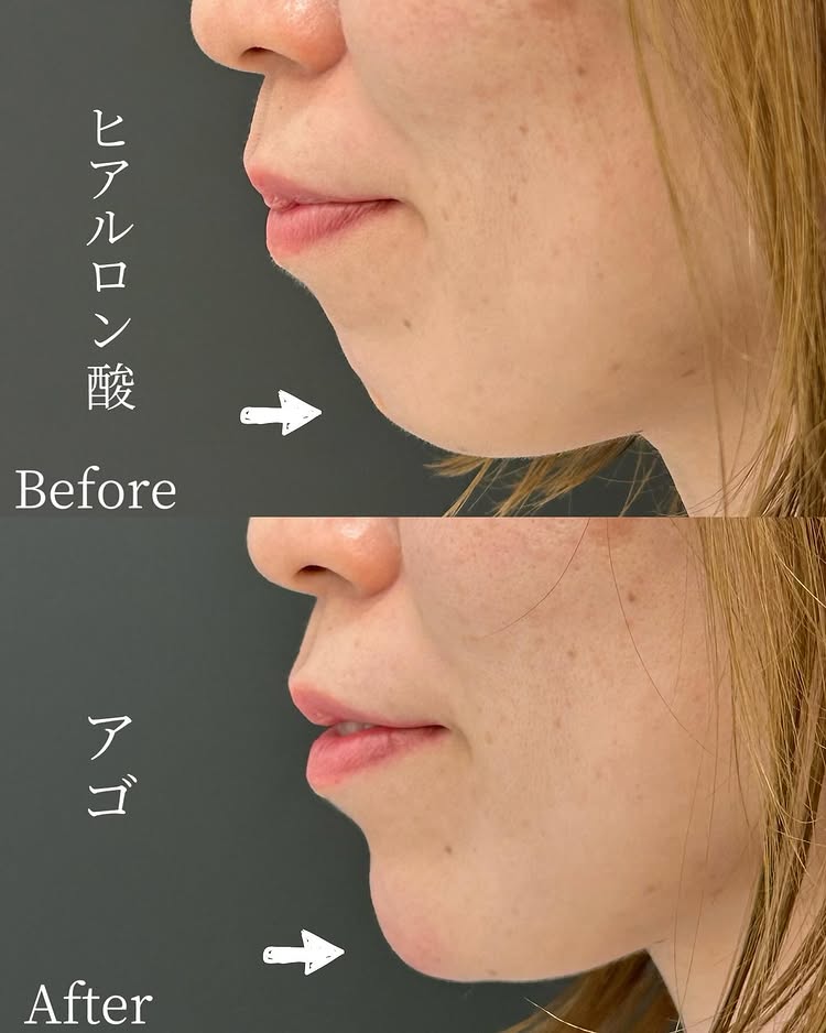 顎のヒアルロン酸の症例写真
