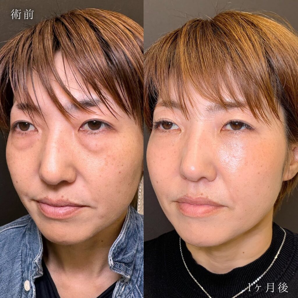 裏ハムラ法と脂肪注入の症例写真 (3)