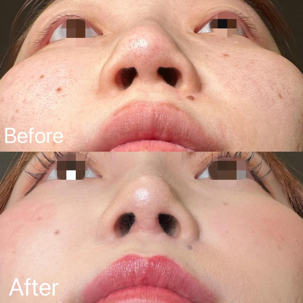 鼻尖形成と軟骨移植の症例写真 (6)