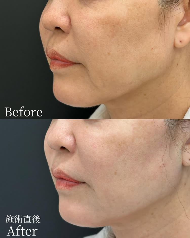 糸リフトの症例写真 (47)