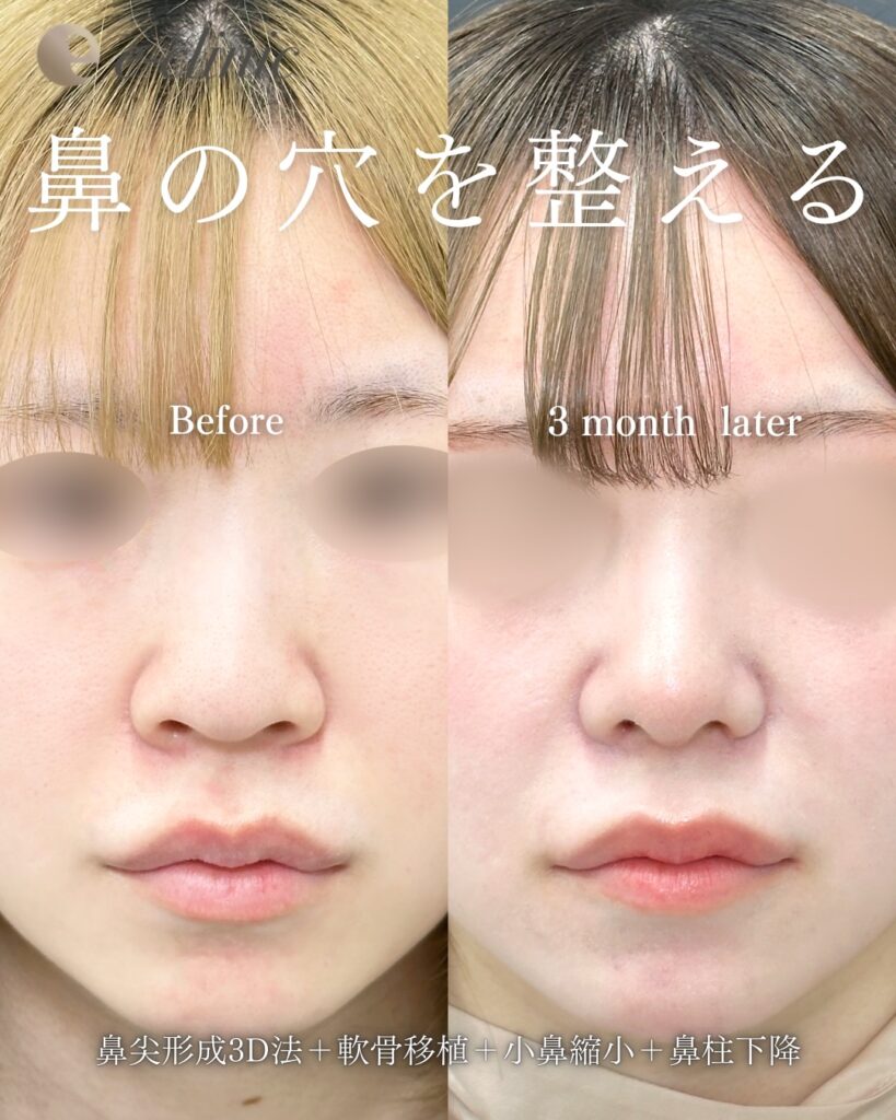 鼻尖形成と鼻中隔延長と耳介軟骨移植と小鼻縮小と鼻柱下降の症例写真 (1)