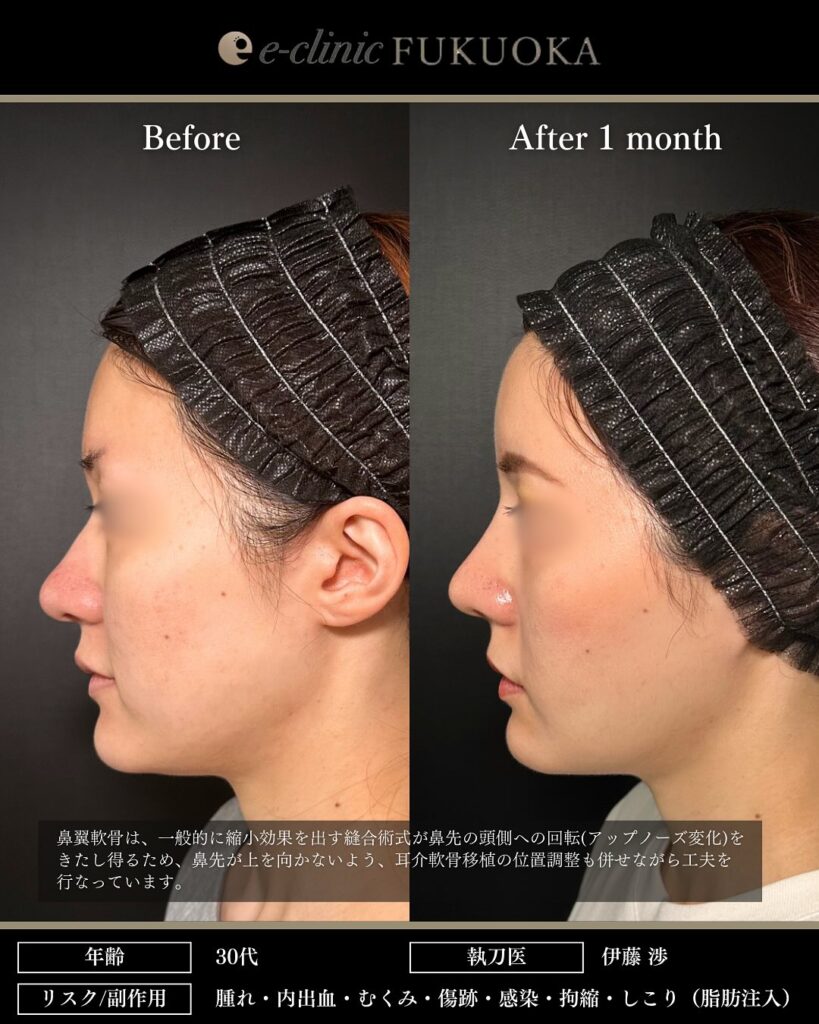 鼻尖形成と軟骨移植と小鼻縮小とプロテーゼと額の脂肪注入と頬の脂肪吸引とジョールファットと糸リフトの症例写真 (8)