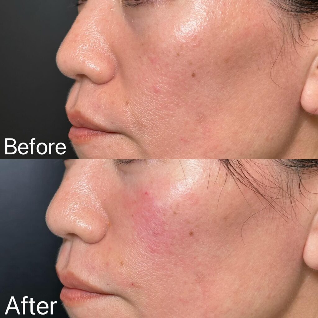 法令線のヒアルロン酸の症例写真 (6)