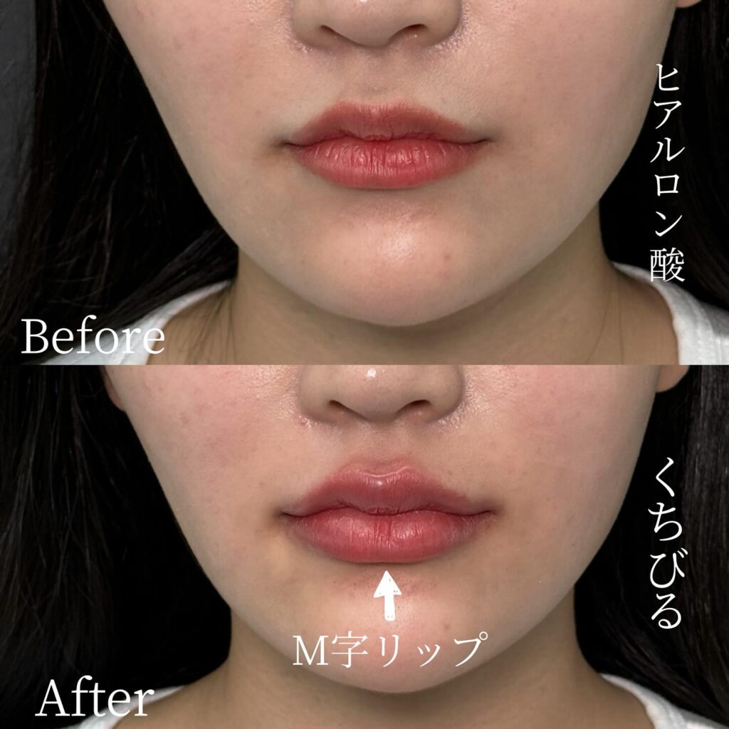 唇のヒアルロン酸の症例写真 (35)