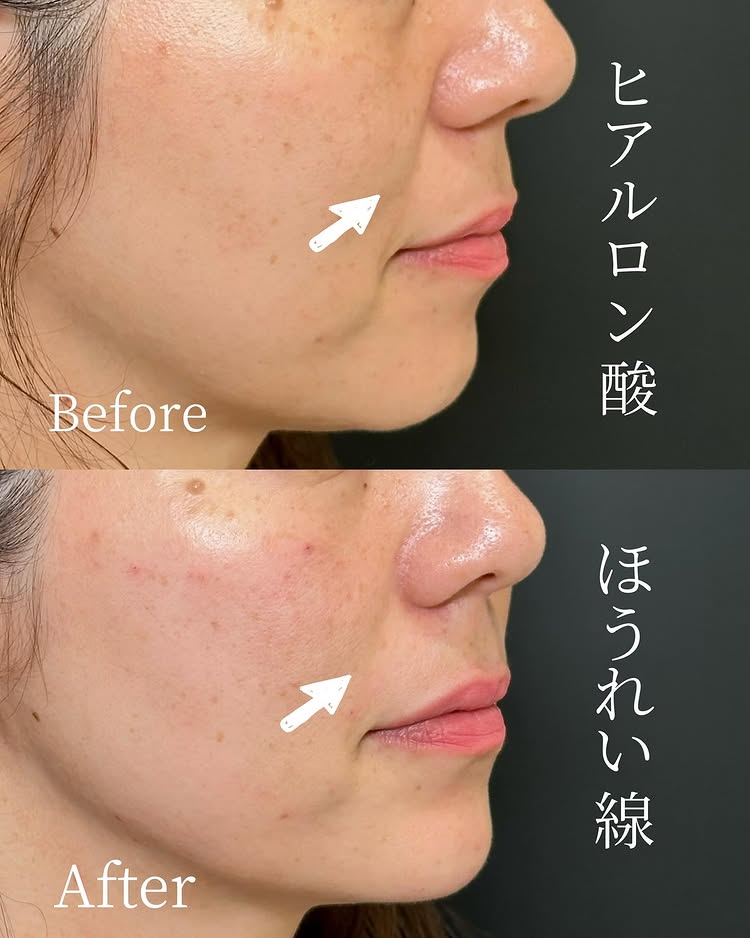 法令線のヒアルロン酸の症例写真 (23)