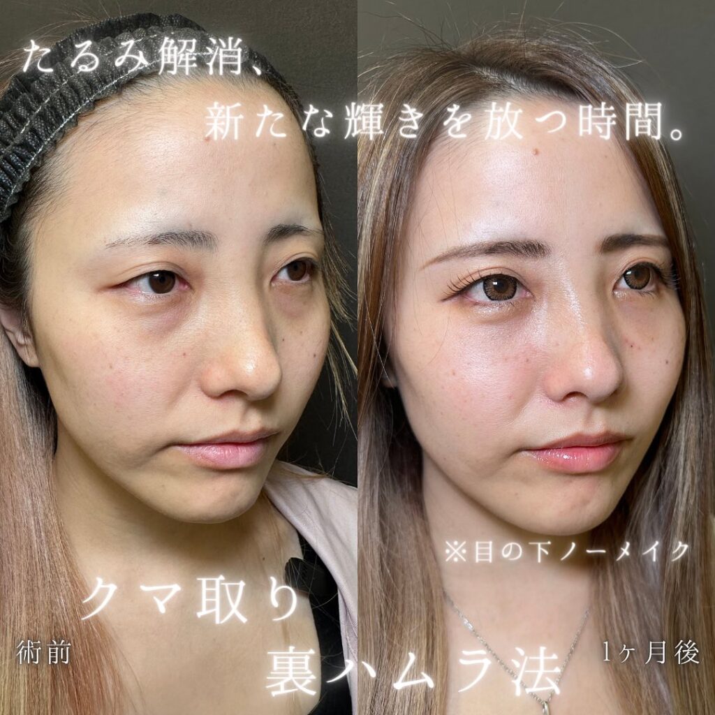 裏ハムラ法の症例写真 (31)