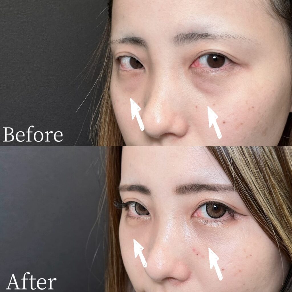 裏ハムラ法の症例写真 (31)