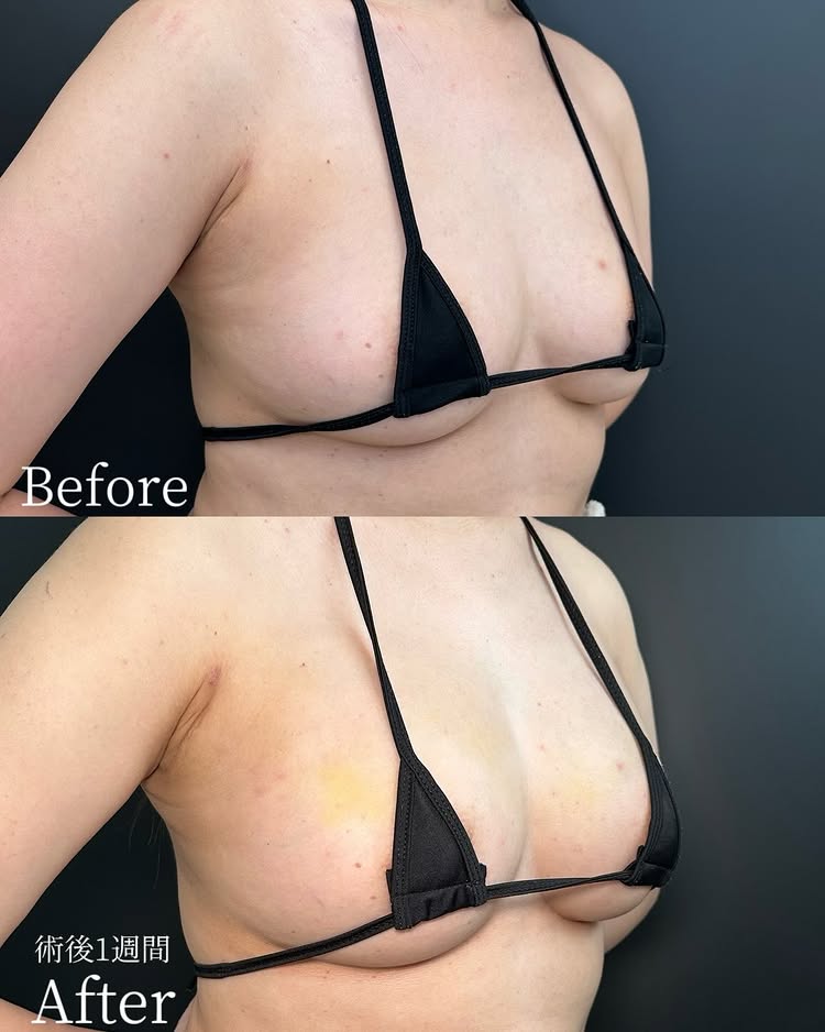 脂肪豊胸の症例写真 (4)
