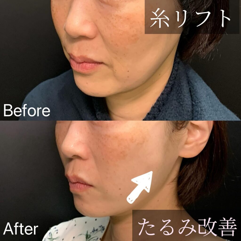 糸リフトの症例写真 (4)