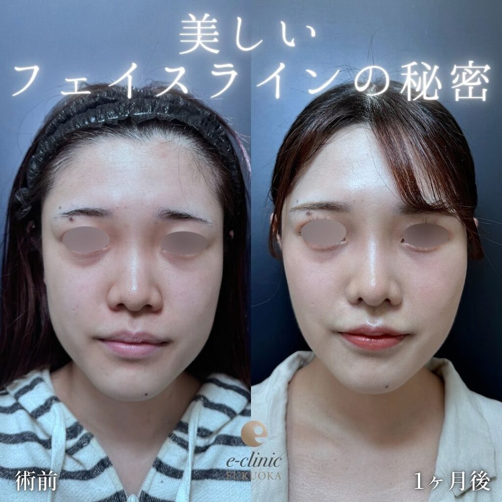 顔の脂肪吸引と糸リフトとバッカルファットの症例写真 (1)