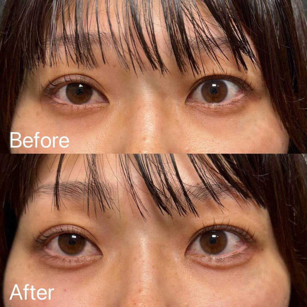 涙袋のヒアルロン酸の症例写真 (6)