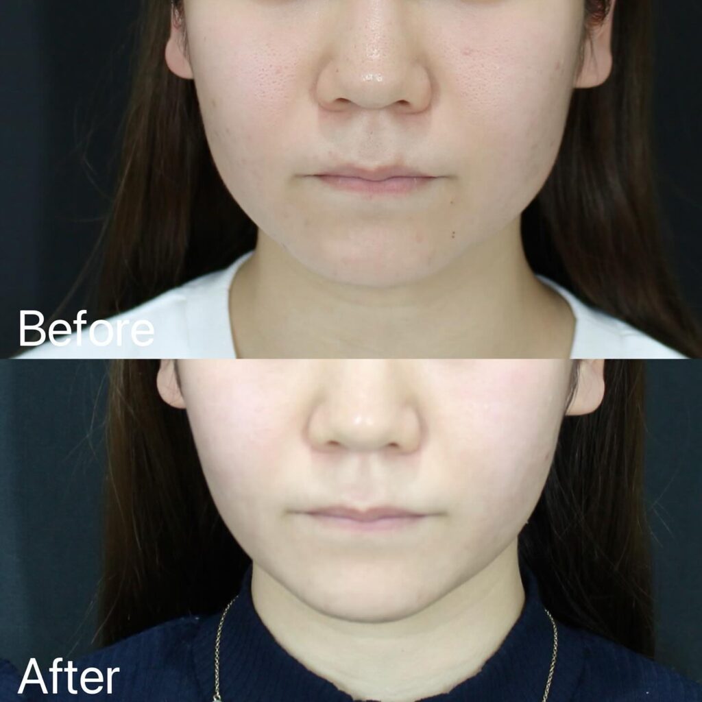 糸リフトの症例写真 (13)